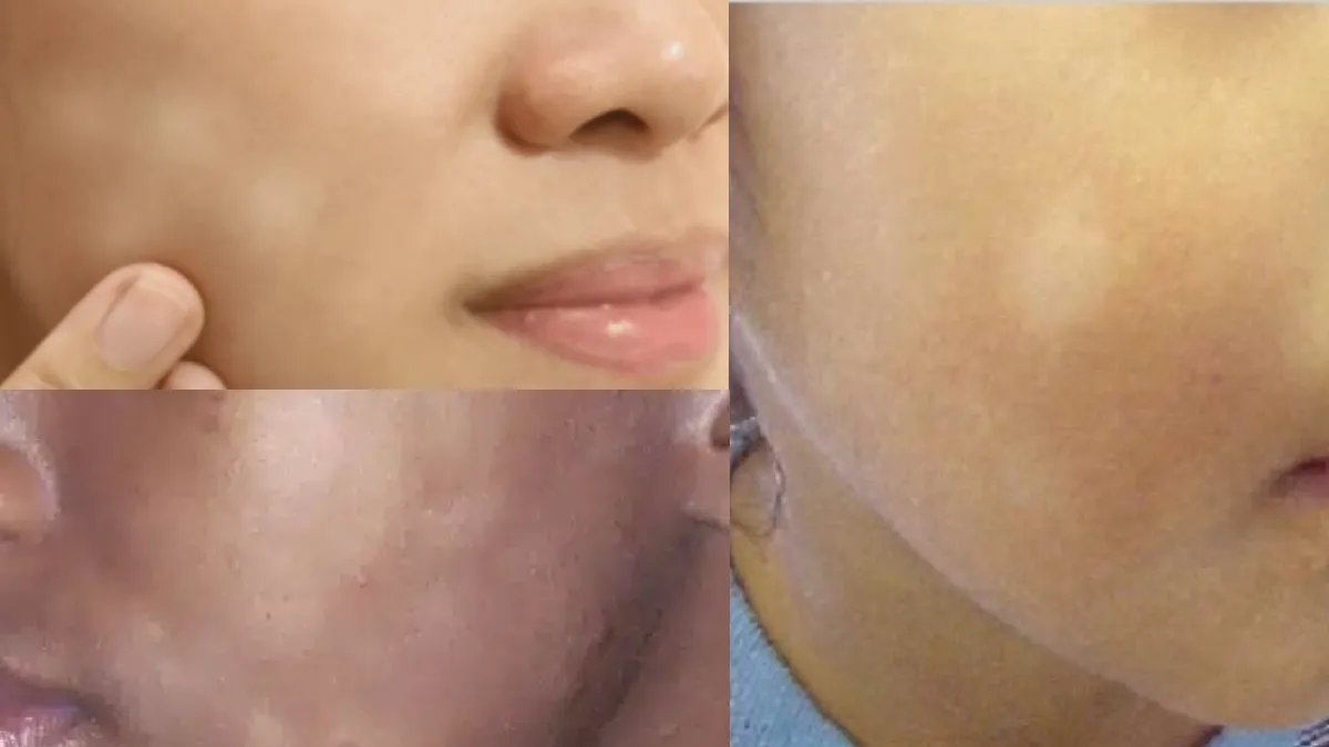 white spots